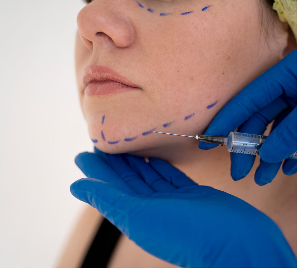 Submental Fat Treatment