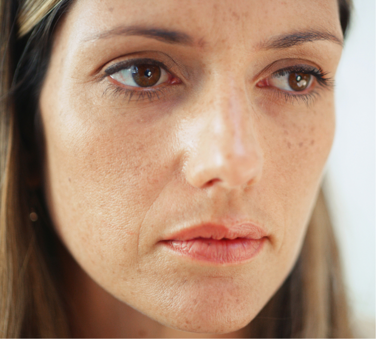 Traitement des taches pigmentaires